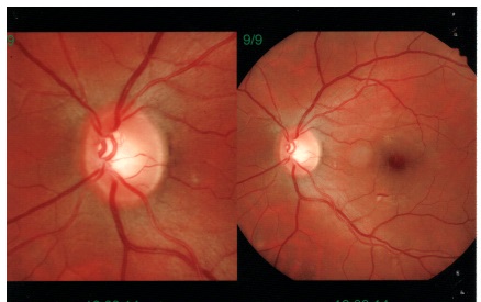 Emorragia retinica isolata in giovane